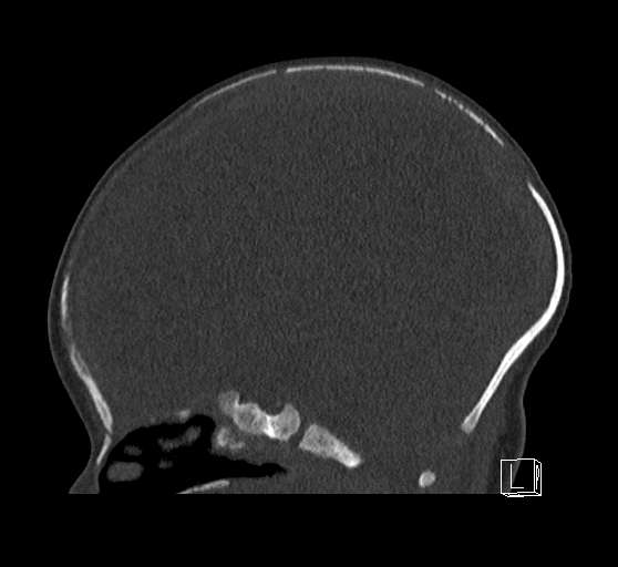 Bilateral subdural hemorrhage and parietal skull fracture (Radiopaedia 26058-26192 Sagittal bone window 52).png