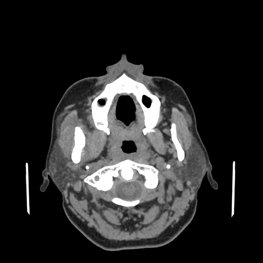 Bisphosphonate-related osteonecrosis of the jaw (Radiopaedia 71324-81642 non-contrast 113).jpg