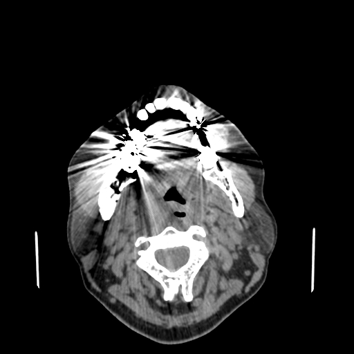 Bisphosphonate-related osteonecrosis of the jaw (Radiopaedia 71324-81642 non-contrast 80).jpg