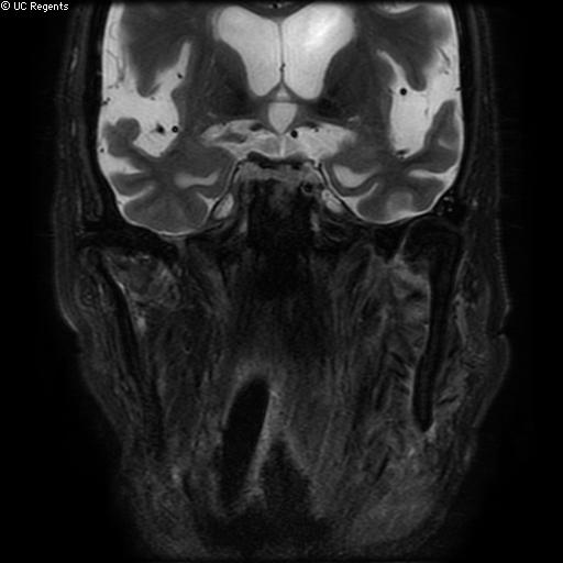 File:Bisphosphonate-related osteonecrosis of the maxilla (Radiopaedia 51367-57101 Coronal T2 fat sat 7).jpg