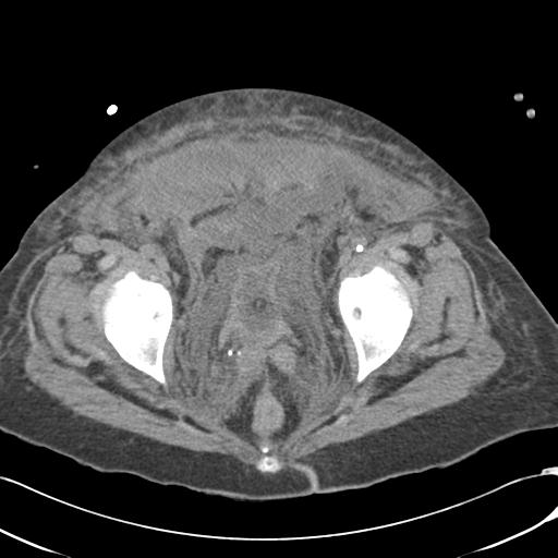 Bladder rupture post renal biopsy (Radiopaedia 30863-31572 Axial non-contrast 79).jpg