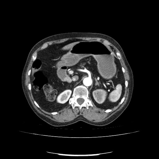 File:Bladder tumor detected on trauma CT (Radiopaedia 51809-57609 A 92).jpg