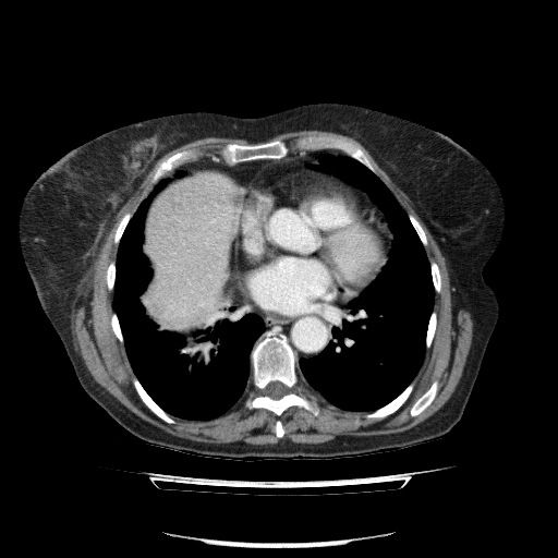 File:Bladder tumor detected on trauma CT (Radiopaedia 51809-57609 B 7).jpg