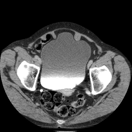 Bladder tumor detected on trauma CT (Radiopaedia 51809-57609 C 124).jpg