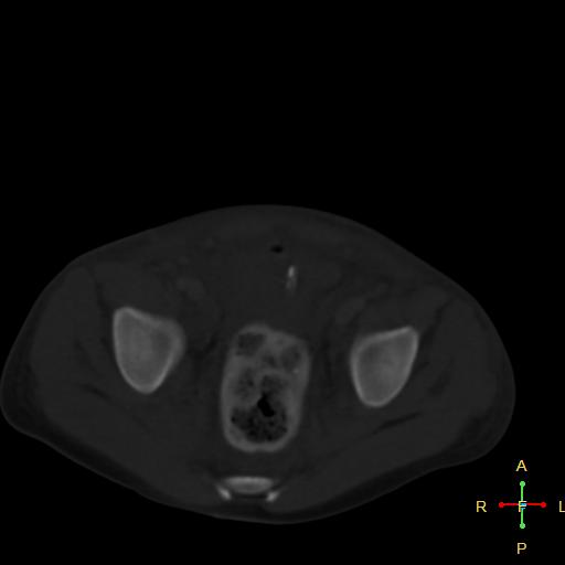 File:Blunt abdominal trauma (Radiopaedia 24780-25044 Axial bone window 14).jpg