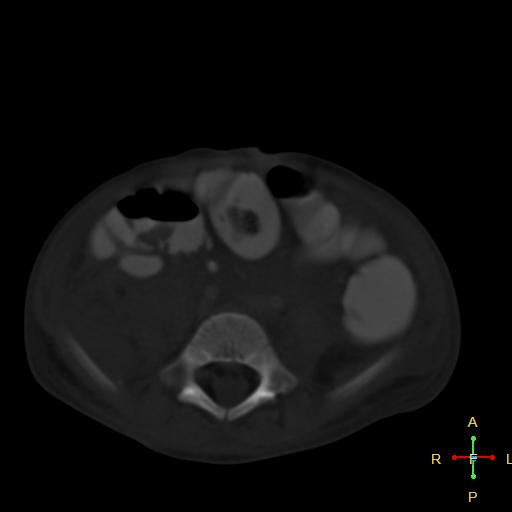 File:Blunt abdominal trauma (Radiopaedia 24780-25044 Axial bone window 4).jpg