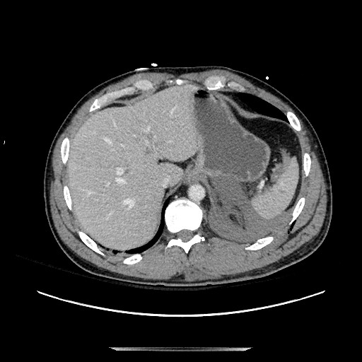 Blunt abdominal trauma with solid organ and musculoskelatal injury with active extravasation (Radiopaedia 68364-77895 A 24).jpg