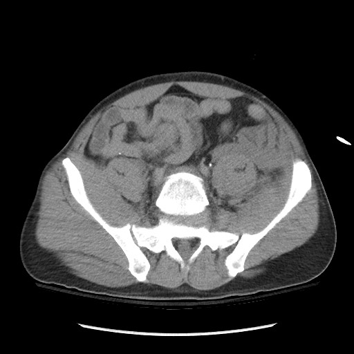 Blunt abdominal trauma with solid organ and musculoskelatal injury with active extravasation (Radiopaedia 68364-77895 Axial C+ delayed 102).jpg