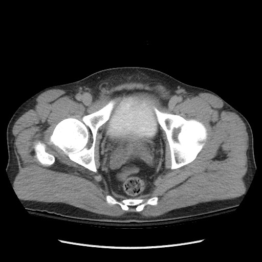 Blunt abdominal trauma with solid organ and musculoskelatal injury with active extravasation (Radiopaedia 68364-77895 Axial C+ delayed 129).jpg