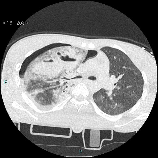 Blunt chest trauma (Swiss cheese sign) (Radiopaedia 38519-40618 Axial lung window 26).jpg