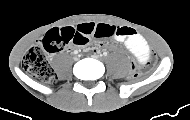 Blunt injury to the small bowel (Radiopaedia 74953-85987 A 123).jpg
