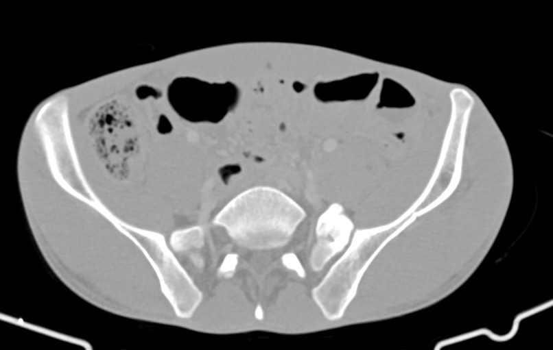 Blunt injury to the small bowel (Radiopaedia 74953-85987 Axial Wide 71).jpg