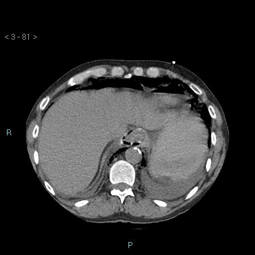 Boerhaave syndrome (Radiopaedia 27683-27897 oral contrast 81).jpg