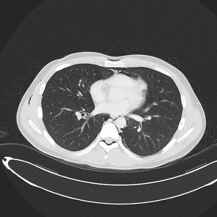 Boerhaave syndrome with mediastinal, axillary, neck and epidural free gas (Radiopaedia 41297-44115 Axial lung window 56).jpg