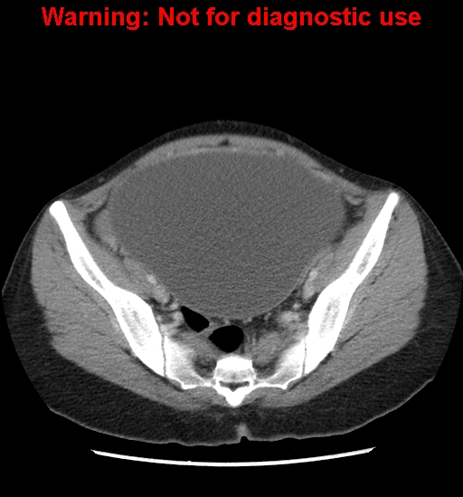 Borderline mucinous cystadenoma of ovary (Radiopaedia 25586-25767 A 86).jpg