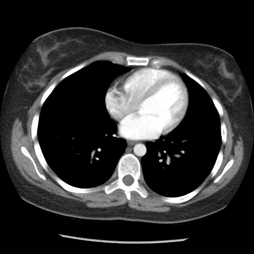 File:Borderline mucinous tumor (ovary) (Radiopaedia 78228-90808 A 29).jpg