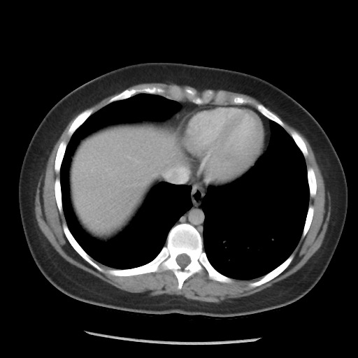 File:Borderline mucinous tumor (ovary) (Radiopaedia 78228-90808 A 63).jpg