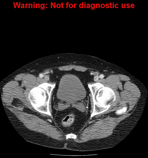 File:Bosniak renal cyst - type IV (Radiopaedia 23402-23466 D 76).jpg