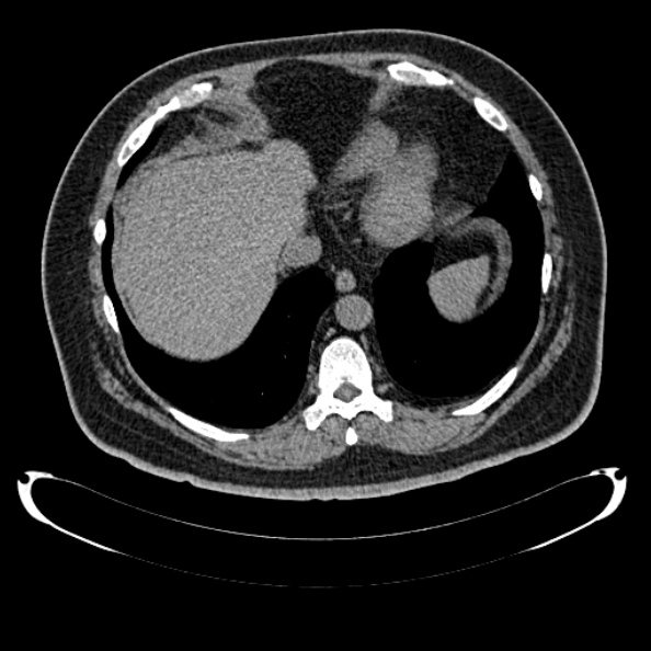 Bosniak renal cyst - type IV (Radiopaedia 24244-24518 Axial non-contrast 39).jpg