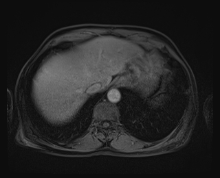 File:Bouveret syndrome (Radiopaedia 61017-68856 Axial T1 C+ fat sat 13).jpg