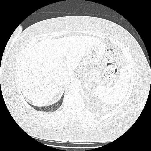 Bovine aortic arch - right internal mammary vein drains into the superior vena cava (Radiopaedia 63296-71875 Axial lung window 172).jpg