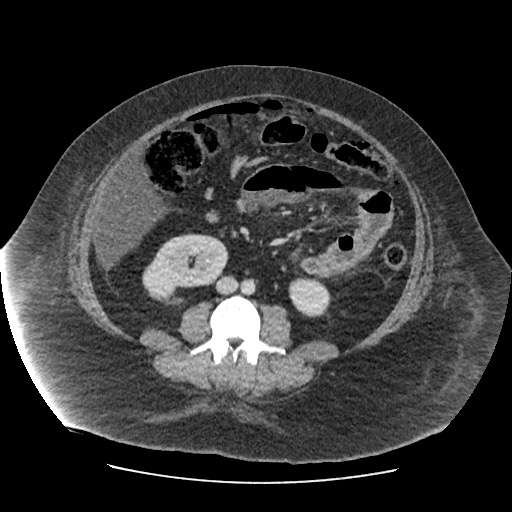 Bowel and splenic infarcts in acute lymphocytic leukemia (Radiopaedia 61055-68915 A 75).jpg