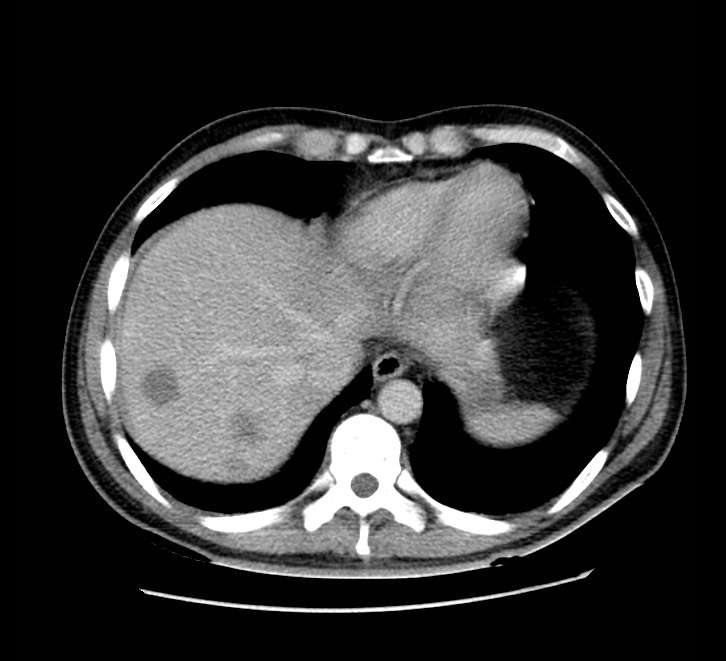Bowel obstruction from colon carcinoma (Radiopaedia 22995-23028 A 10).jpg