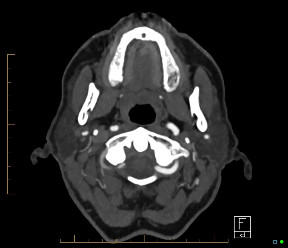 Brachiocephalic trunk stenosis (Radiopaedia 87242-103519 A 69).jpg