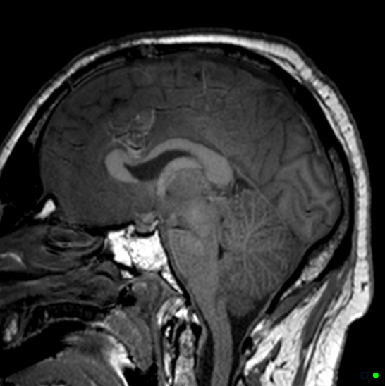 Brain death on MRI and CT angiography (Radiopaedia 42560-45689 Sagittal T1 25).jpg