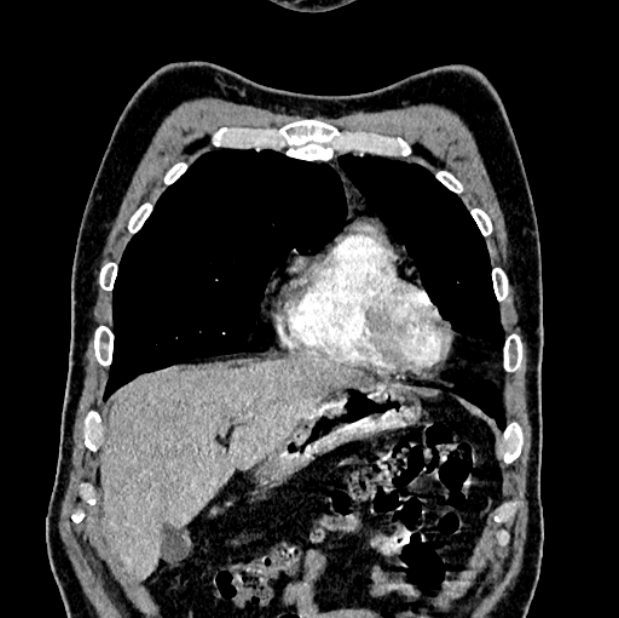 Brain metastases - lung cancer primary (Radiopaedia 75060-86116 C+ arterial phase 11).jpg