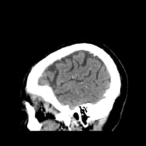 Brain metastasis (Radiopaedia 42617-45760 D 4).jpg