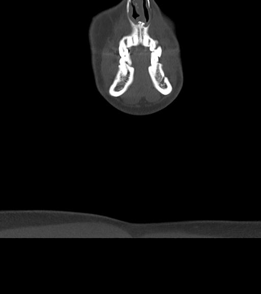 Branchial cleft cyst (Radiopaedia 31167-31875 Coronal bone window 11).jpg