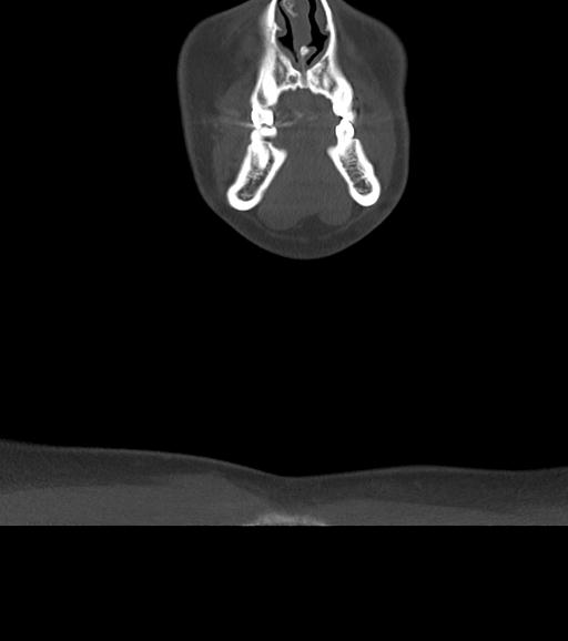 File:Branchial cleft cyst (Radiopaedia 31167-31875 Coronal bone window 13).jpg