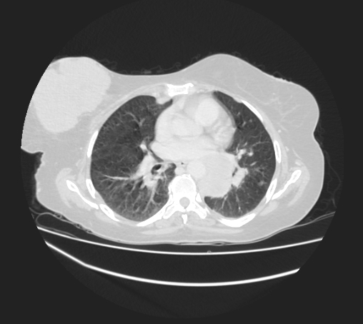Breast metastases from facial malignant melanoma (Radiopaedia 60316-67975 Axial lung window 55).jpg