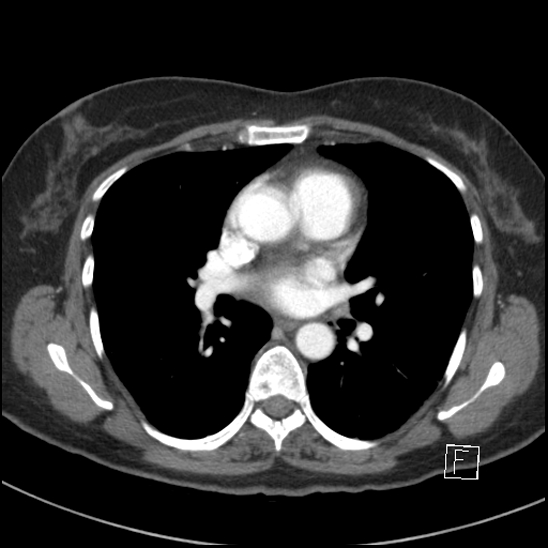 Breast metastases from renal cell cancer (Radiopaedia 79220-92225 A 47).jpg