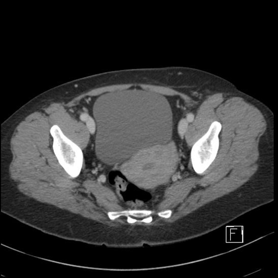 File:Breast metastases from renal cell cancer (Radiopaedia 79220-92225 C 102).jpg