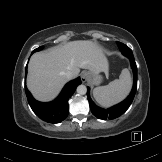 Breast metastases from renal cell cancer (Radiopaedia 79220-92225 C 11).jpg