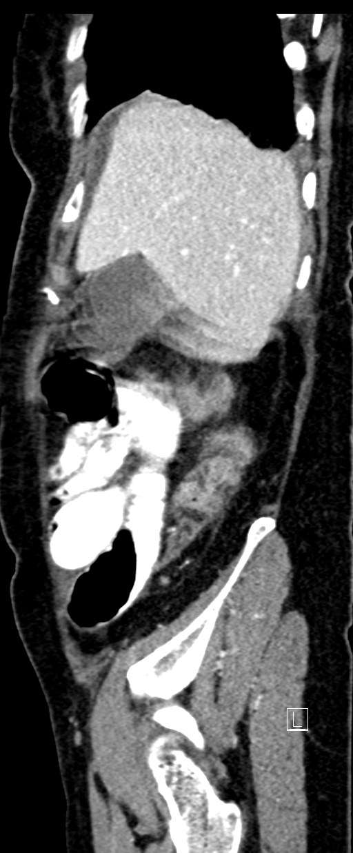 Broad ligament hernia (Radiopaedia 84802-100276 C 70).jpg