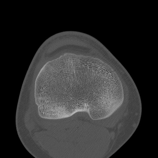 Brodie abscess of the tibia (Radiopaedia 58984-66250 Axial bone window 61).jpg