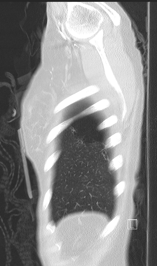 Bronchial atresia (Radiopaedia 73677-84470 Sagittal lung window 51).jpg