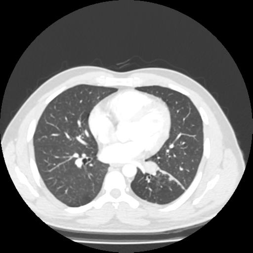 Bronchial carcinoid (Radiopaedia 80013-93291 Axial lung window 68).jpg