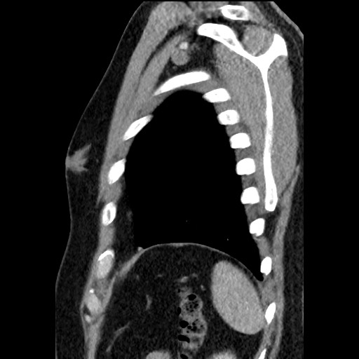 File:Bronchial carcinoid tumor (Radiopaedia 67377-76764 E 60).jpg