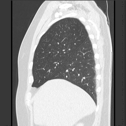 File:Bronchial carcinoid tumor (Radiopaedia 67377-76764 Sagittal lung window 16).jpg