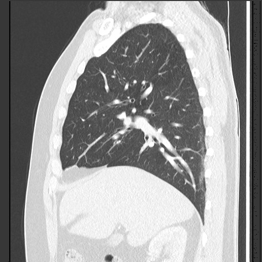 Bronchial carcinoid tumor (Radiopaedia 67377-76764 Sagittal lung window 24).jpg