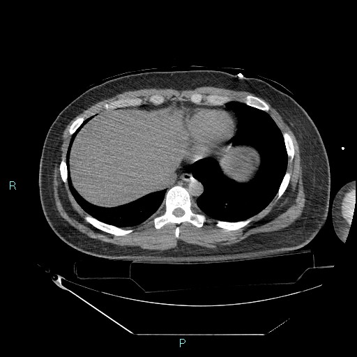 File:Bronchial carcinoid tumor (Radiopaedia 78272-90870 Axial non-contrast 84).jpg