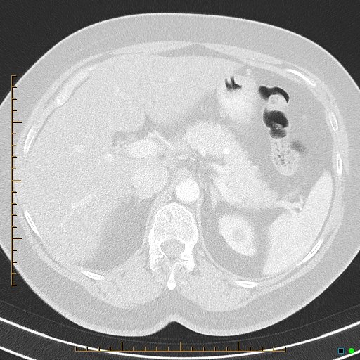 File:Bronchial diverticula (Radiopaedia 79512-92675 Axial lung window 52).jpg