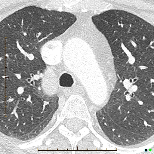 File:Bronchial diverticula (Radiopaedia 79512-92677 Axial lung window 2).jpg