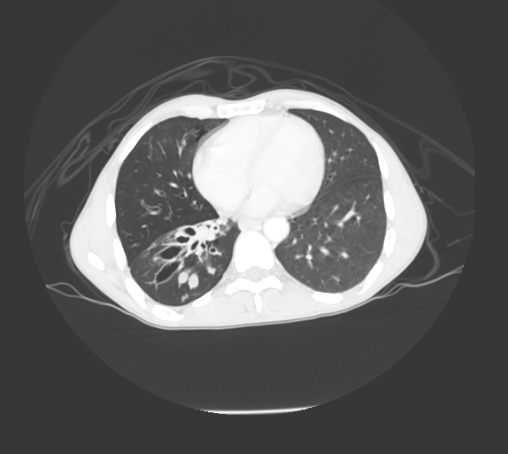 File:Bronchiectasis in Crohn disease (Radiopaedia 60311-67977 Axial lung window 4).jpg
