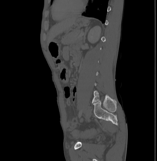 Bronchiectasis in Crohn disease (Radiopaedia 60311-67977 Sagittal bone window 169).jpg