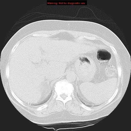 Bronchoalveolar carcinoma (Radiopaedia 13224-13233 Axial lung window 43).jpg
